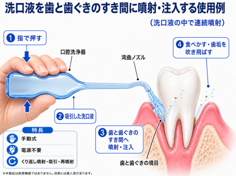 歯と歯茎の隙間に噴射・注入