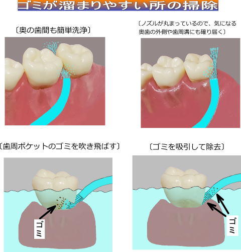 歯周の掃除