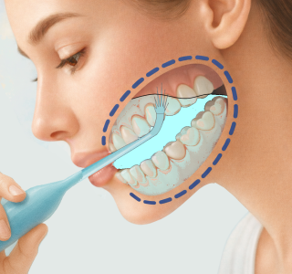 ノズルを口腔内の洗口液に入れ洗口液を吸引しながら上顎の歯間に 繰り返し水流を吹付けている透視画像