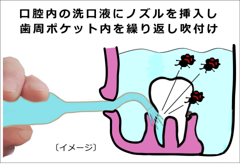 口腔内の洗口液にノズルを挿入し歯周ポケット内を繰返し吹付け