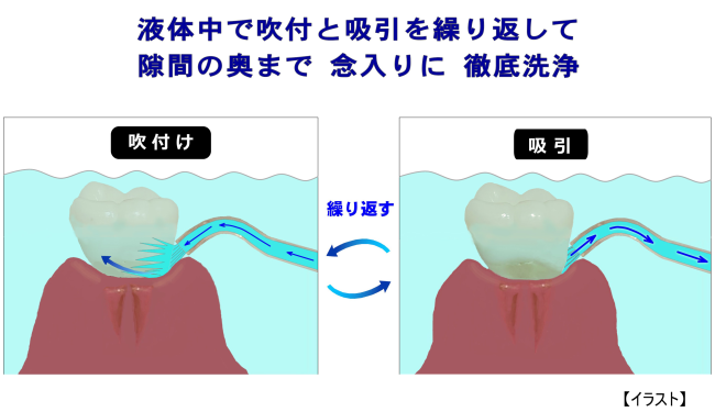 吹付と吸引を繰返して念入りにケア