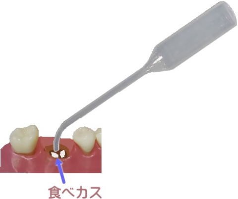 抜歯したところに入った食べかすの除去