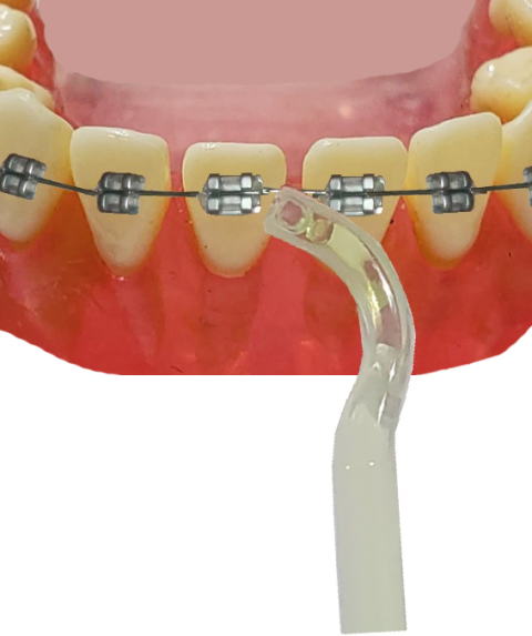 下の歯の外側の矯正装置周囲を、液を狭い隙間に吹き付けて、水流で掃除