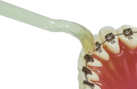 下の歯の裏側の矯正装置周囲も水流で仕上げ磨き